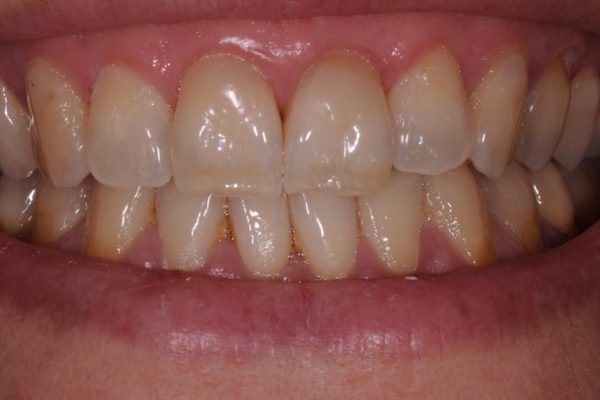 protesi-fissa-e-mobile