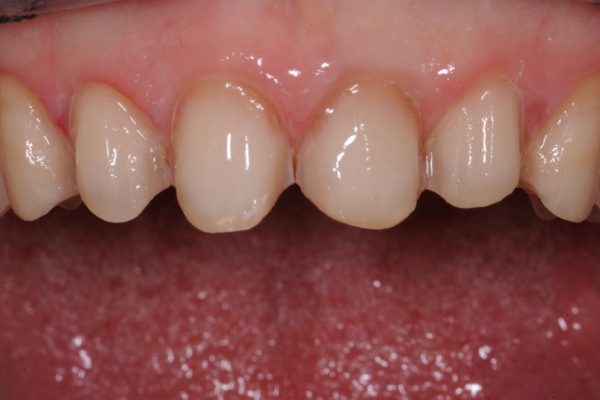 protesi-fissa-e-mobile