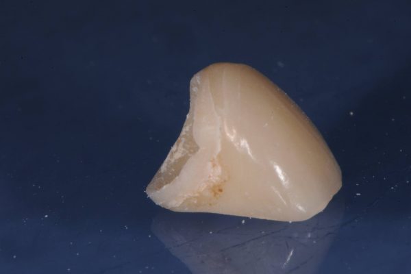 protesi-fissa-e-mobile