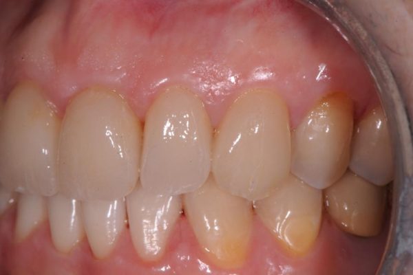 protesi-fissa-e-mobile