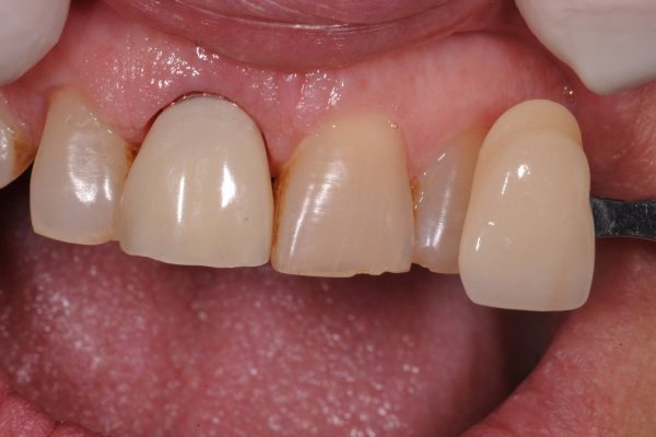 protesi-fissa-e-mobile