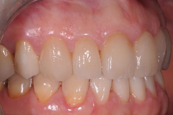 protesi-fissa-e-mobile