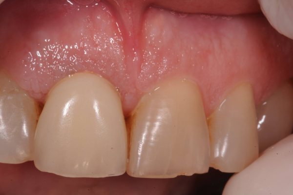 protesi-fissa-e-mobile