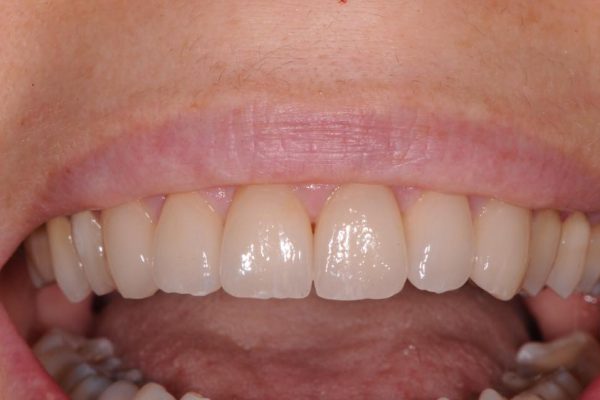 protesi-fissa-e-mobile