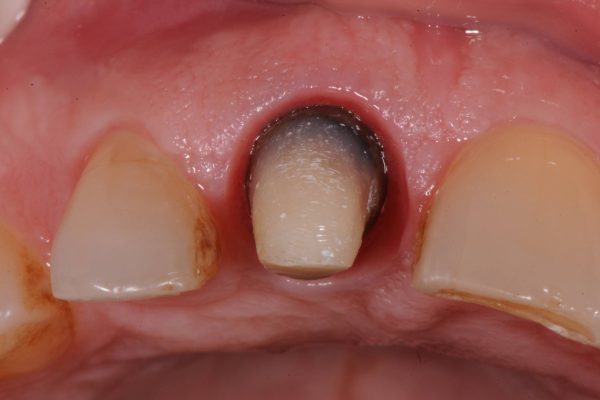 protesi-fissa-e-mobile