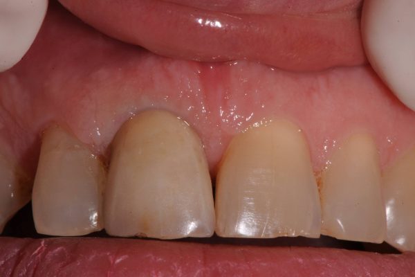 protesi-fissa-e-mobile